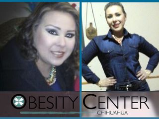 Antes y después Obesity Center Chihuahua