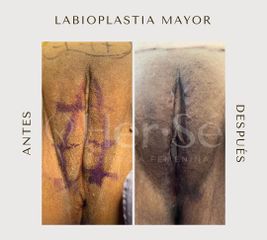 Labioplastia - Her Sé