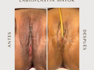 Labioplastia antes y después - 869714
