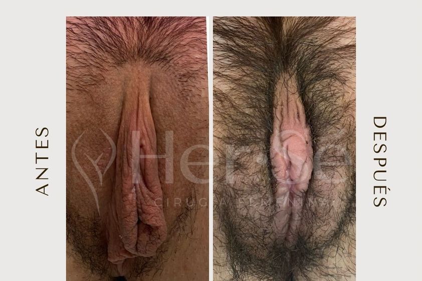 Labioplastia antes y después - 869716