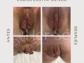 Labioplastia antes y después - 869717