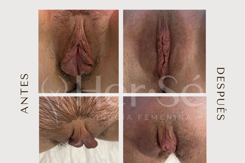 Labioplastia antes y después - 869717