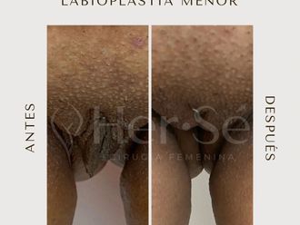 Labioplastia antes y después - 869718