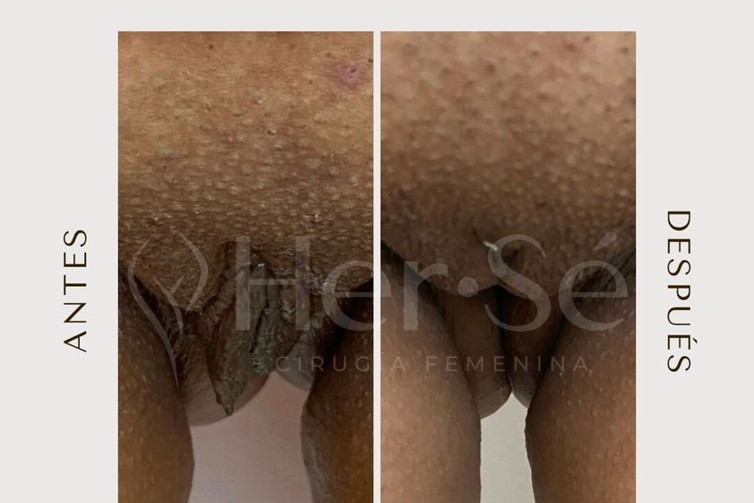 Labioplastia antes y después - 869718