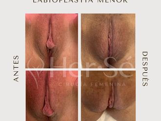 Labioplastia antes y después - 869719
