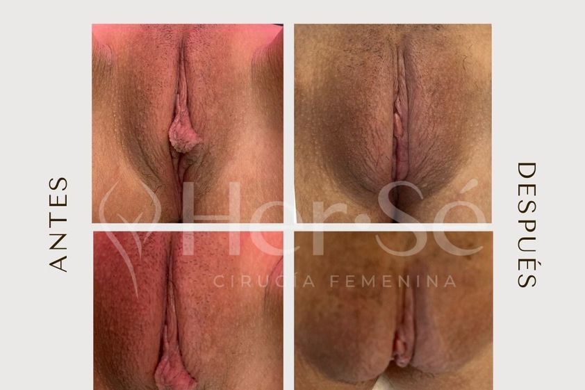 Labioplastia antes y después - 869719