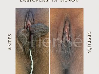 Labioplastia antes y después - 869721