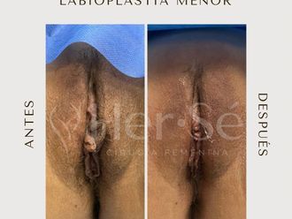 Labioplastia antes y después - 869722
