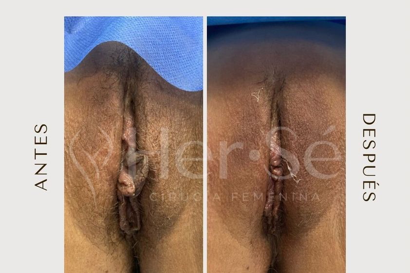 Labioplastia antes y después - 869722