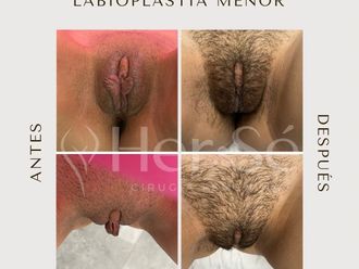 Labioplastia antes y después - 869723