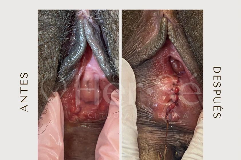 Himenoplastia antes y después - 869724