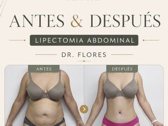 Abdominoplastia antes y después - 880710