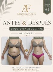 Abdominoplastía - Dr. Armando R. Flores García