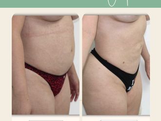 Liposucción antes y después - 880802