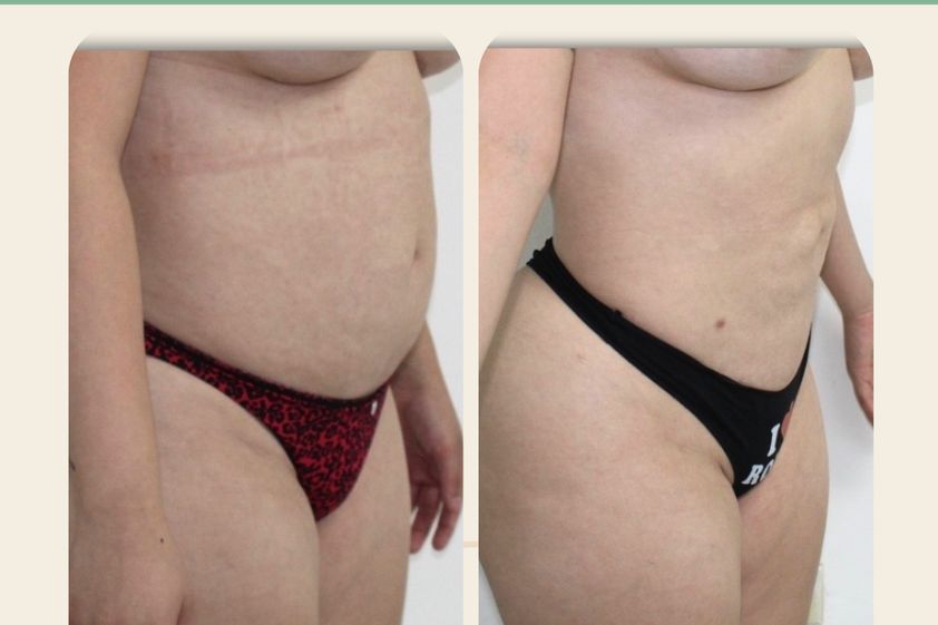 Liposucción antes y después - 880802