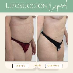 Liposucción Corporal - Dr. Armando R. Flores García