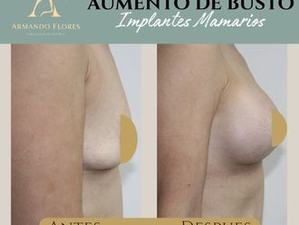 Aumento de busto antes y después - 880803