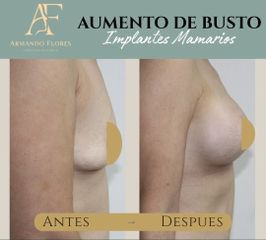 Aumento de Busto - Dr. Armando R. Flores García