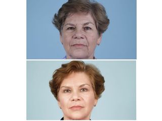 Antes y después de un Rejuvenecimiento Facial