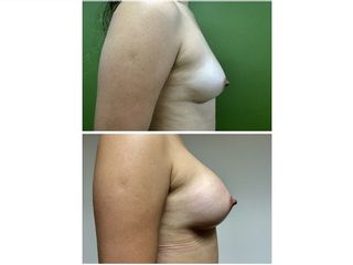 Antes y después de un aumento de busto 