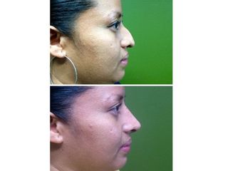Antes y después de una Rinoplastia
