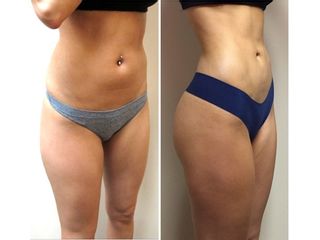 Antes y después de una Lipoescultura