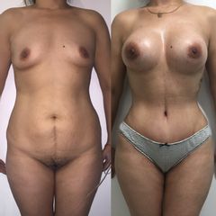 Antes y después de un Mommy makeover - Bódika Aesthetic Center