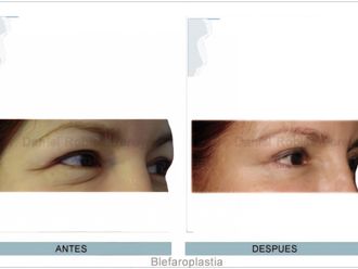 Blefaroplastia antes y después - 873301