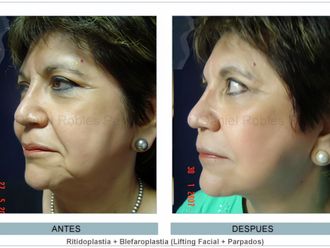 Cirugía facial antes y después - 873302