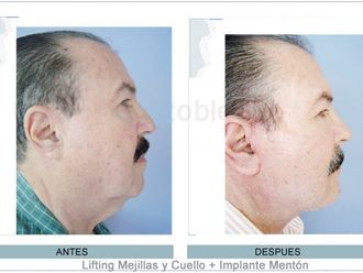 Cirugía facial antes y después - 873303