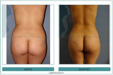 Lipoescultura - Dr. Daniel Robles Pereyra