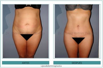 Lipoabdominoplastia - Dr. Daniel Robles Pereyra