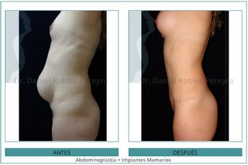 Abdominoplastia + Implantes-Mamarios - Dr. Daniel Robles Pereyra