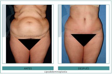 Lipoabdominoplastia - Dr. Daniel Robles Pereyra