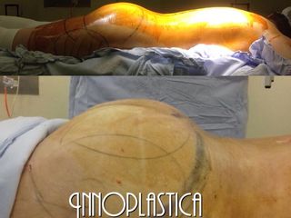 Antes y después de Lipoescultura