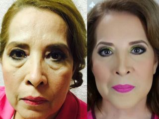 Antes y después de Blefaroplastia 