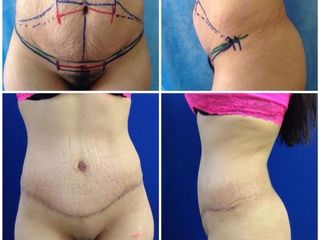 Antes y después de Lipoescultura