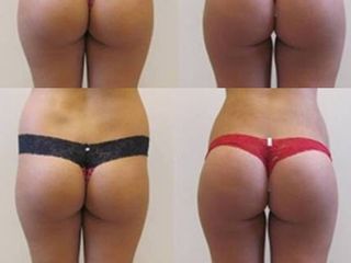 Antes y después de Gluteoplastia