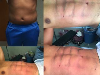 Antes y después de Abdominoplastia