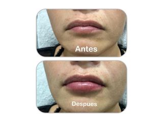 Aumento de labios con Ácido hialurónico
