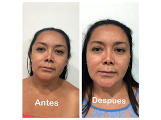 Antes y después de Hilos tensores