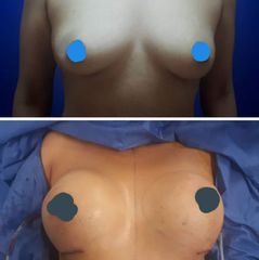 Antes y después de Aumento de busto