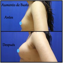 Antes y después de Aumento de busto