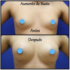 Antes y después de Aumento de busto