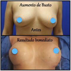 Antes y después de Aumento de busto