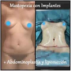 Antes y después de Mastopexia con Implantes + Abdominoplastia y lipo