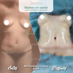 abdominoplastia - Dr. Humberto Osnaya Moreno