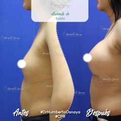 Antes y después de Aumento de busto