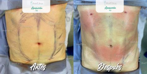 Antes y después de Liposucción