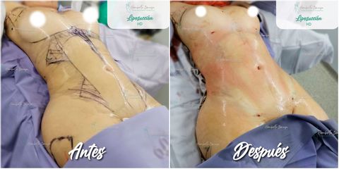 Antes y después de Liposucción